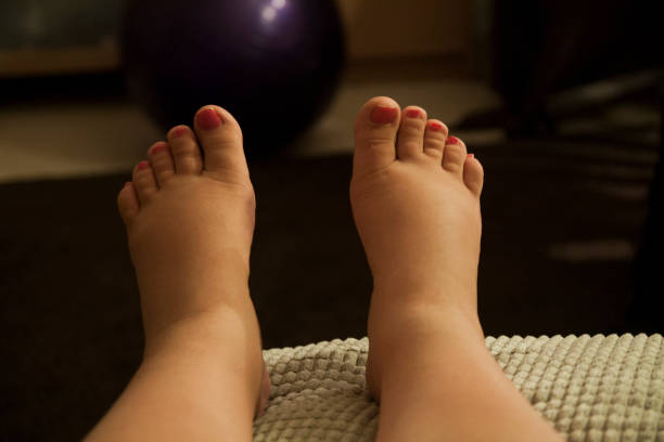 This is a photo of swollen feet during pregnancy