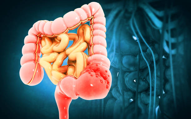 Colon cancer. Colon disease. 3d illustration