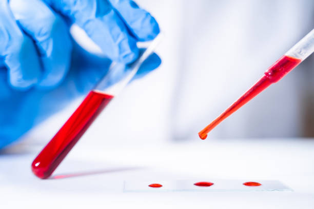Lab technician performs a blood test, drips blood onto a glass for microscopy