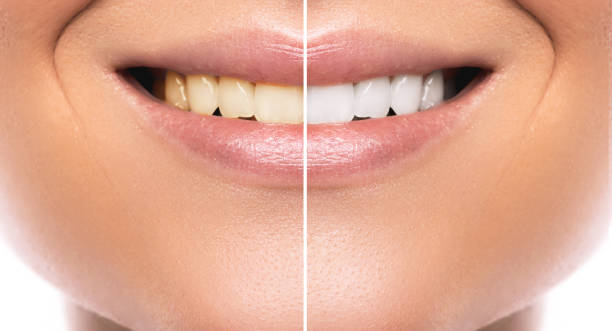 Which vitamin deficiency causes teeth to become yellow